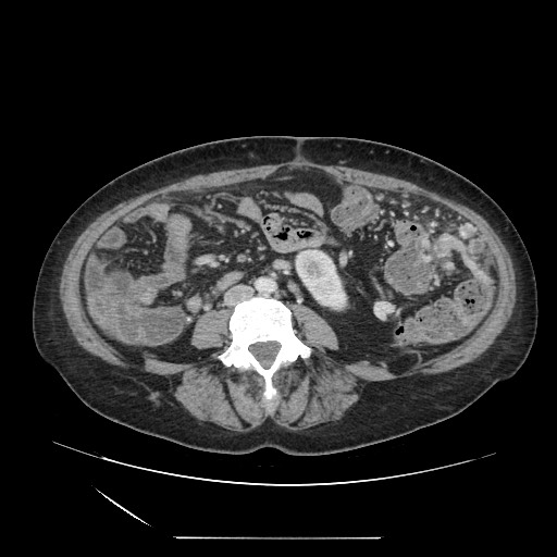 Acinar cell carcinoma of the pancreas (Radiopaedia 75442-86669 Axial C+ portal venous phase 86).jpg