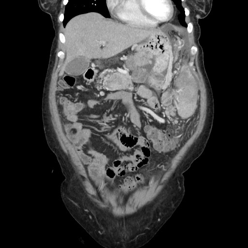 Acinar cell carcinoma of the pancreas (Radiopaedia 75442-86669 Coronal C+ portal venous phase 36).jpg