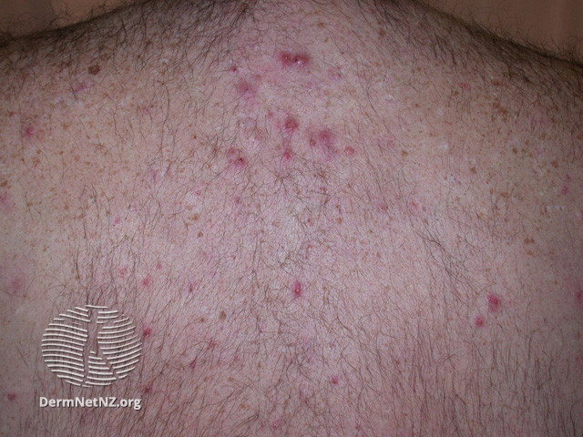 File:Acne affecting the back images (DermNet NZ acne-acne-back-189).jpg