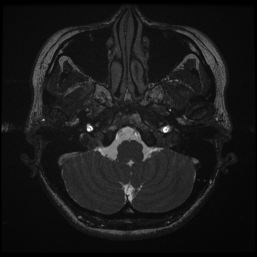 Acoustic neuroma (Radiopaedia 34049-35283 Axial 23).png