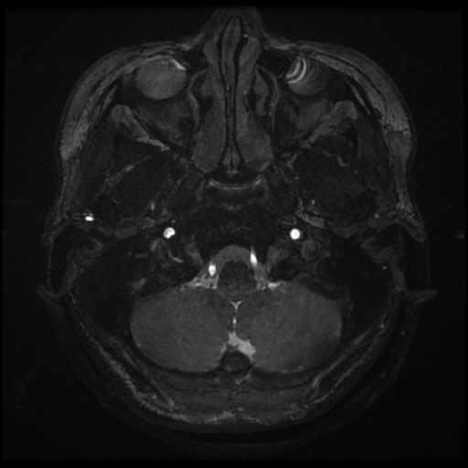 Acoustic neuroma (Radiopaedia 34049-35283 Axial 7).png