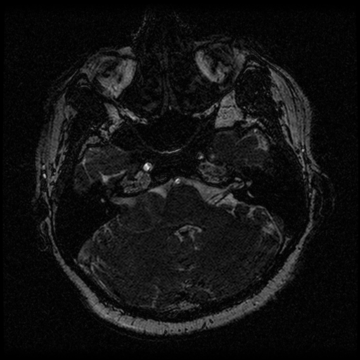 Acoustic schwannoma (Radiopaedia 33045-34060 Axial T2 25).png