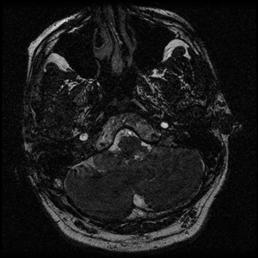 File:Acoustic schwannoma (Radiopaedia 39170-41387 Axial FIESTA 35).png