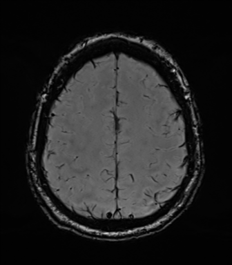 Acoustic schwannoma (Radiopaedia 50846-56358 Axial SWI 74).png