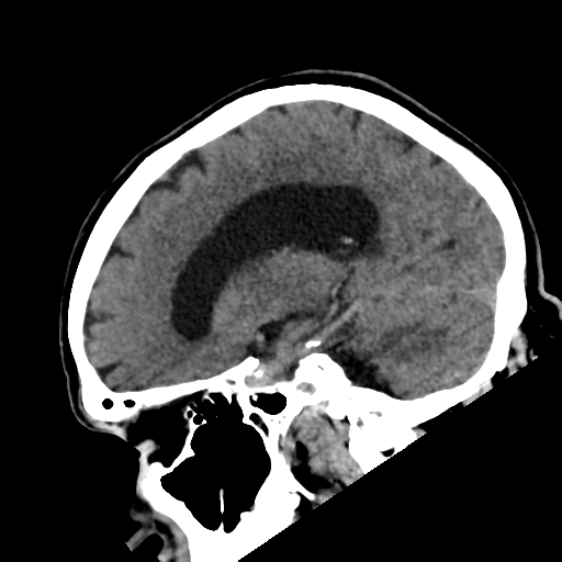 File:Acoustic schwannoma (Radiopaedia 55729-62280 Sagittal non-contrast 13).png