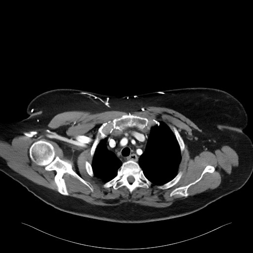Acromioclavicular joint cyst (Radiopaedia 58455-65610 Axial C+ arterial phase 31).jpg