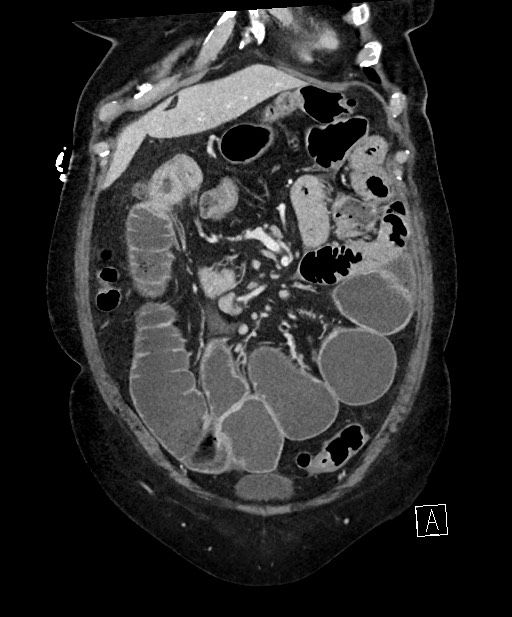 Active Crohn disease (Radiopaedia 59394-66750 Coronal C+ portal venous phase 22).jpg