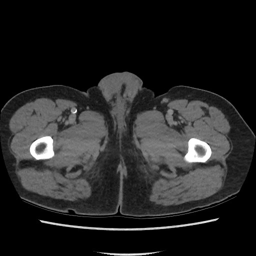 File:Active colonic bleed on CT (Radiopaedia 49765-55025 Axial C+ delayed 94).jpg