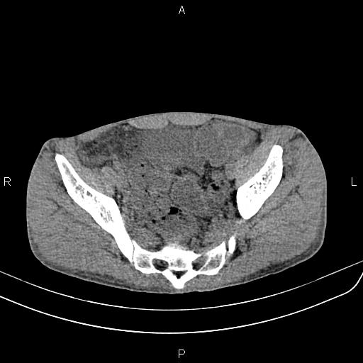 Active crohn disease (Radiopaedia 87133-103397 Axial non-contrast 85).jpg