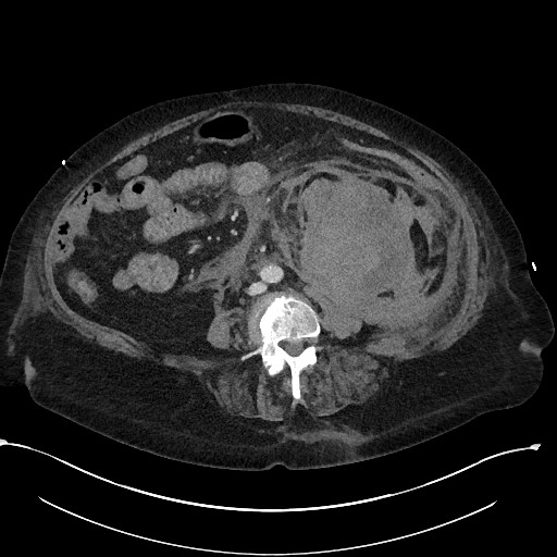 File:Active renal extravasation with large subcapsular and retroperitoneal hemorrhage (Radiopaedia 60975-68796 Axial 227).jpg