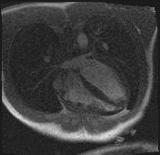 Active right ventricular cardiac sarcoidosis (Radiopaedia 55596-62100 Axial Dynamic perfusion scan MOCO 45).jpg
