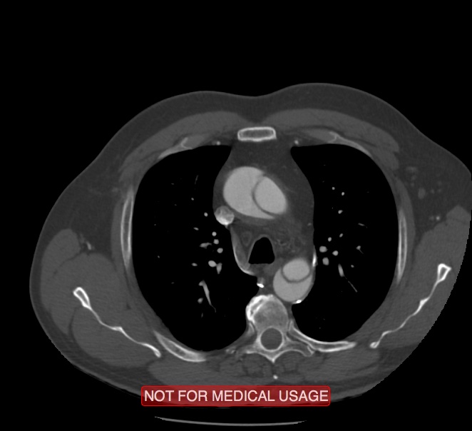 Acute aortic dissection - Stanford type A (Radiopaedia 40661-43285 Axial C+ arterial phase 13).jpg