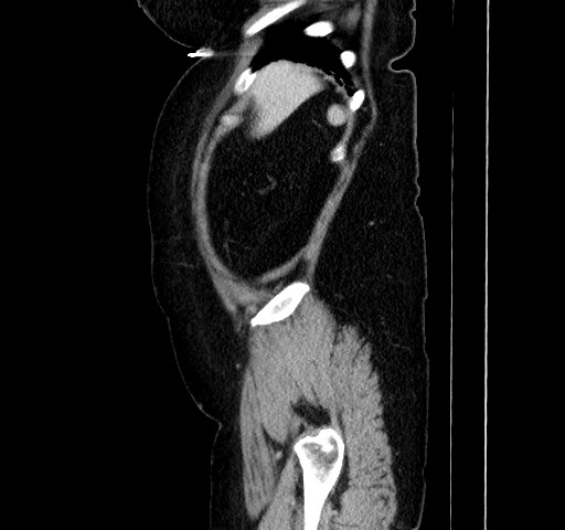 Acute appendicitis, heterotaxy syndrome (Radiopaedia 66884-76202 Sagittal C+ portal venous phase 26).jpg