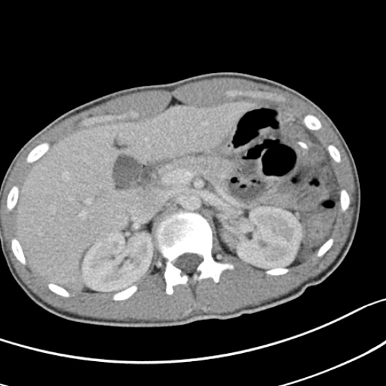 Acute appendicitis (Radiopaedia 32614-33572 Axial C+ portal venous phase 18).jpg