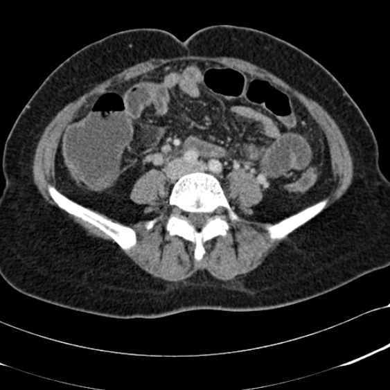 File:Acute appendicitis (Radiopaedia 48792-53822 Axial C+ portal venous phase 71).jpg