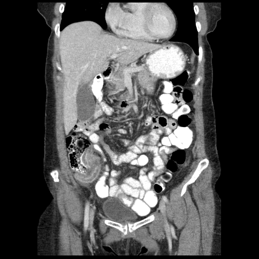 Acute appendicitis (Radiopaedia 52672-58589 Coronal C+ portal venous phase 24).jpg