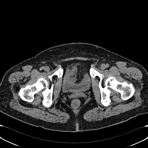 Acute appendicitis (Radiopaedia 58627-65818 Axial non-contrast 86).jpg