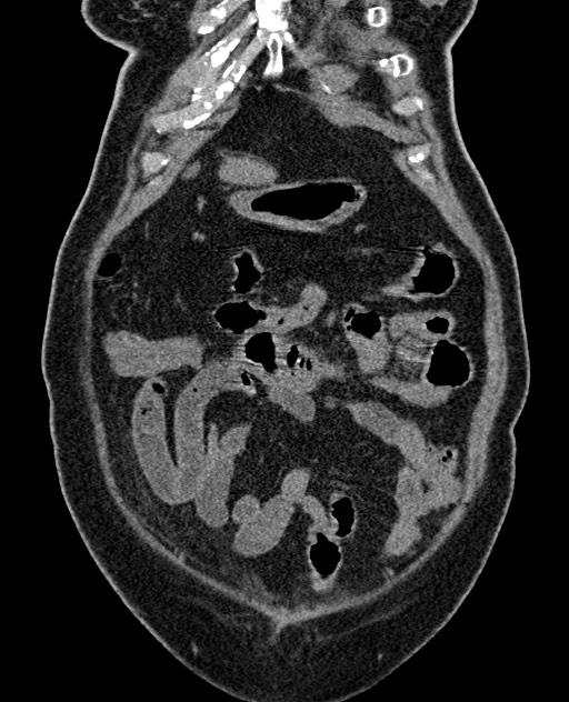Acute appendicitis (Radiopaedia 58627-65818 Coronal non-contrast 26).jpg