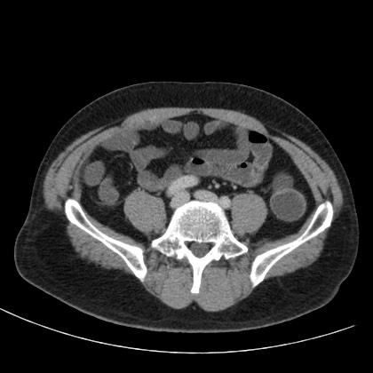 File:Acute appendicitis (Radiopaedia 66513-75790 Axial C+ portal venous phase 58).jpg