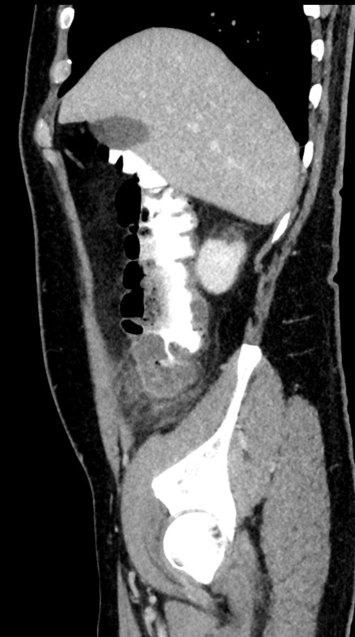 Acute appendicitis (Radiopaedia 77016-88960 Sagittal C+ portal venous phase 89).jpg