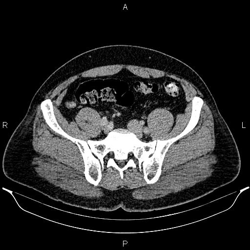 File:Acute appendicitis (Radiopaedia 84780-100240 Axial C+ portal venous phase 82).jpg