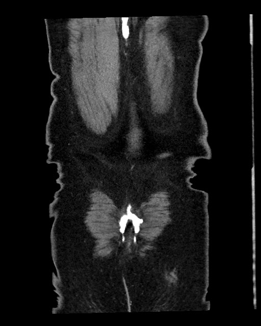 Acute appendicitis - large appendicoliths (Radiopaedia 61805-69820 Coronal C+ portal venous phase 127).jpg