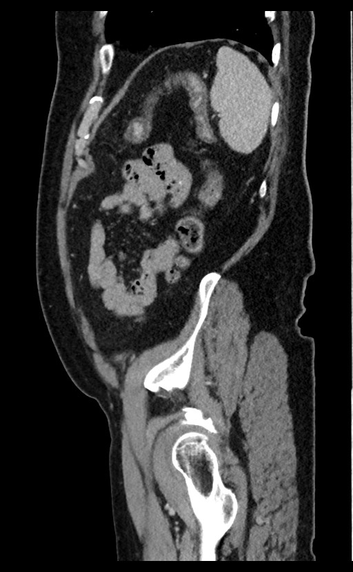 Acute appendicitis - large appendicoliths (Radiopaedia 61805-69820 Sagittal C+ portal venous phase 20).jpg