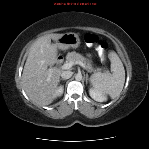 File:Acute appendicitis complicated by ovarian vein thrombophlebitis (Radiopaedia 16172-15851 Axial C+ portal venous phase 32).jpg