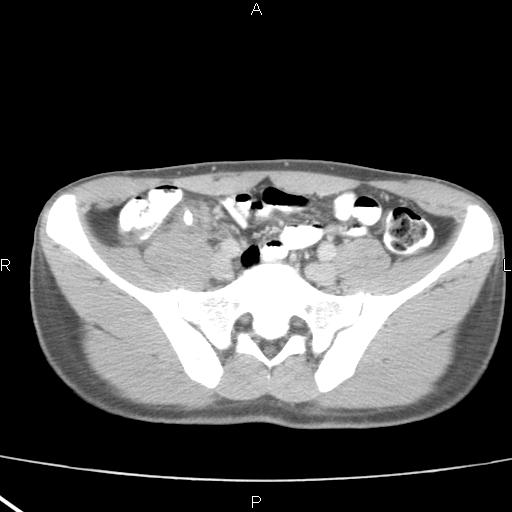 File:Acute appendicitis with CT arrowhead sign (Radiopaedia 21474-21411 Axial C+ portal venous phase 29).jpg