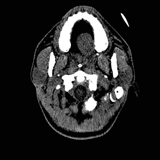 File:Acute basilar artery occlusion (Radiopaedia 43582-46985 Axial non-contrast 20).jpg