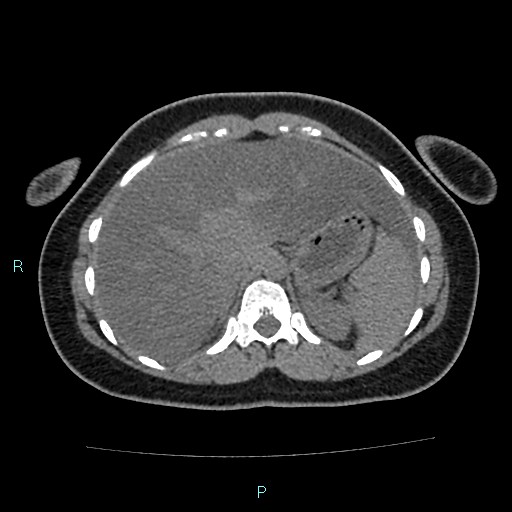 File:Acute bilateral pyelonephritis (Radiopaedia 37146-38881 Axial non-contrast 24).jpg