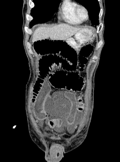 Acute bowel ischemia (Radiopaedia 87695-104114 Coronal C+ portal venous phase 107).jpg