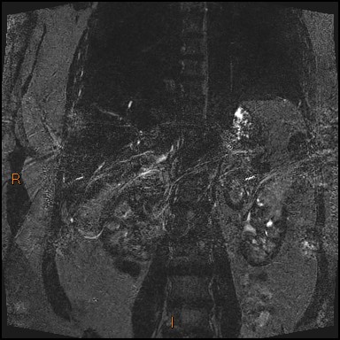 File:Acute cholecystitis with gallbladder neck calculus (Radiopaedia 42795-45971 Coronal Turbo spin echo 6).jpg