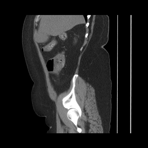 Acute cholecystitis with tensile fundus sign (Radiopaedia 71394-81723 Sagittal non-contrast 52).jpg