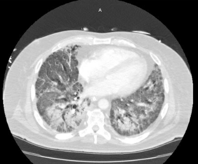 File:Acute cor pulmonale (ultrasound) (Radiopaedia 83508-98818 Axial lung window 57).jpg