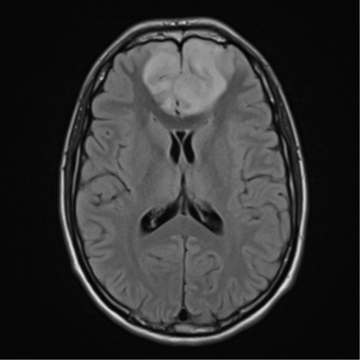 File:Acute disseminated encephalomyelitis (ADEM) (Radiopaedia 65319-74349 Axial FLAIR 18).png