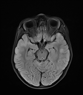 File:Acute disseminating encephalomyelitis with bilateral optic neuritis (Radiopaedia 79676-92886 Axial FLAIR 10).jpg