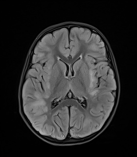 File:Acute disseminating encephalomyelitis with bilateral optic neuritis (Radiopaedia 79676-92886 Axial FLAIR 14).jpg
