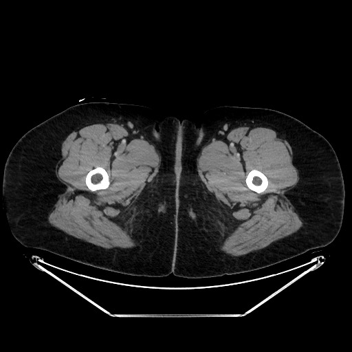 Acute diverticulitis - transverse colon (Radiopaedia 87063-103327 Axial C+ portal venous phase 193).jpg