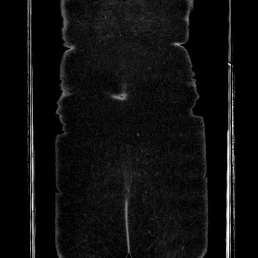 Acute diverticulitis - transverse colon (Radiopaedia 87063-103327 Coronal C+ portal venous phase 157).jpg