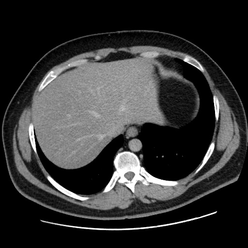 File:Acute diverticulitis with localized perforation (Radiopaedia 41296-44113 Axial C+ portal venous phase 14).jpg