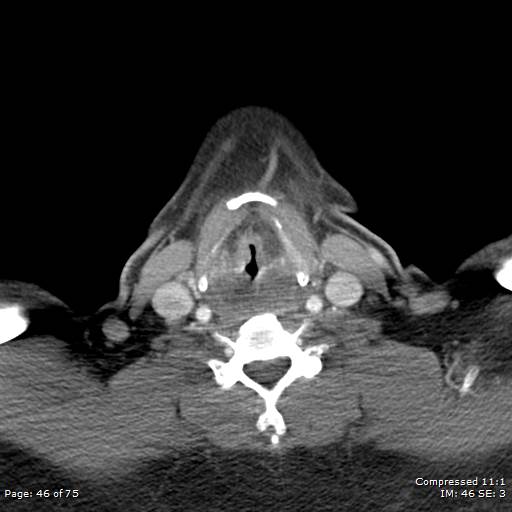 Acute epiglottitis (Radiopaedia 54375-60590 Axial C+ arterial phase 46).jpg
