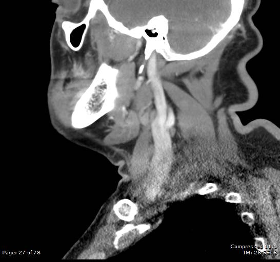 Acute epiglottitis (Radiopaedia 54375-60590 Sagittal C+ arterial phase 27).jpg
