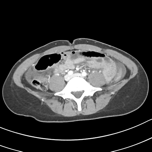 Acute gangrenous appendicitis with perforation (Radiopaedia 40152-42662 Axial C+ portal venous phase 44).png