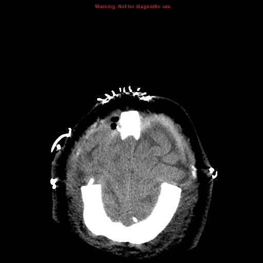 Acute hemorrhagic leukoencephalitis (Radiopaedia 14076-43697 Axial non-contrast 46).jpg