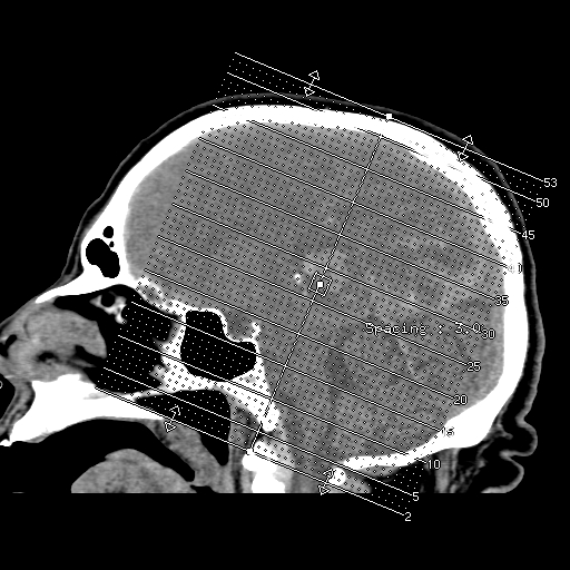 Acute hemorrhagic stroke (Radiopaedia 17507-17223 Axial non-contrast 1).jpg
