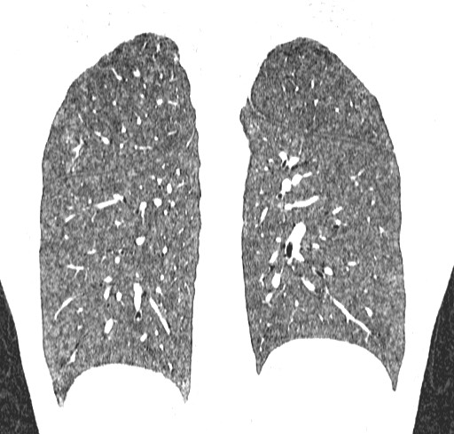 Acute hypersensitivity pneumonitis (Radiopaedia 85293-100870 Coronal lung window 98).jpg
