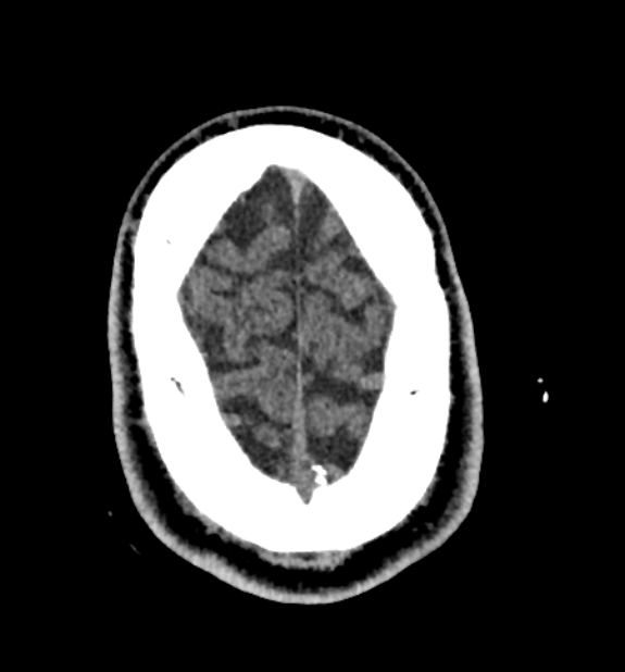 Acute ischemic stroke - posterior circulation territory (Radiopaedia 77670-89881 non-contrast 84).jpg