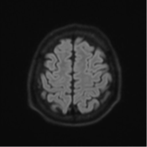 Acute left middle cerebral artery territory infarct with clot retrieval (Radiopaedia 47732-52433 Axial DWI 55).png