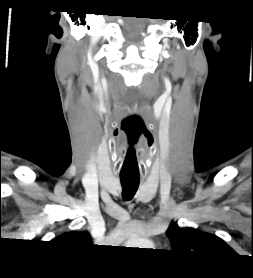Acute longus colli calcific tendinitis (Radiopaedia 72495-83036 Coronal C+ arterial phase 32).jpg